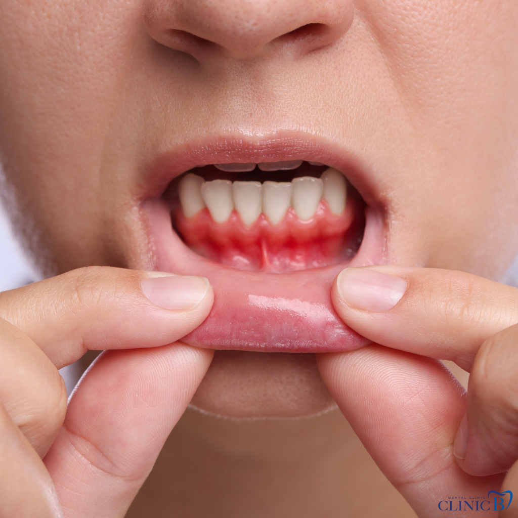 Diş Eti Tedavisi ve Estetiği(Periodontoloji)